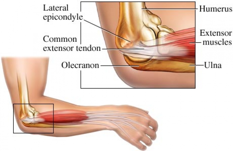 Tennis Elbow can be caused by Pickleball